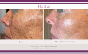 Remove sun and age spots, diffuse redness and uneven pigmentation on the face and body - Catherine's Laser & Beauty Salon, Letterkenny, Co. Donegal, Ireland