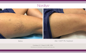 Before and after one Nd:YAG laser treatment of leg veins. Catherine's Laser and Beauty Salon, Letterkenny Co. Donegal, Ireland