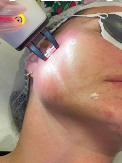 Non Ablative Fractional Laser treatment  stimulates natural healing - Catherine's Skin, Laser & Beauty Salon, Donegal, Ireland